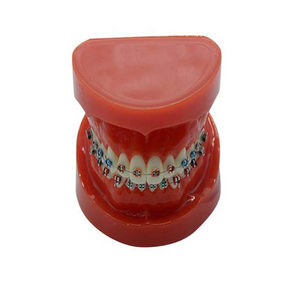 نموذج دراسة ، مع دعامة ثابتة للأسنان (عادي)