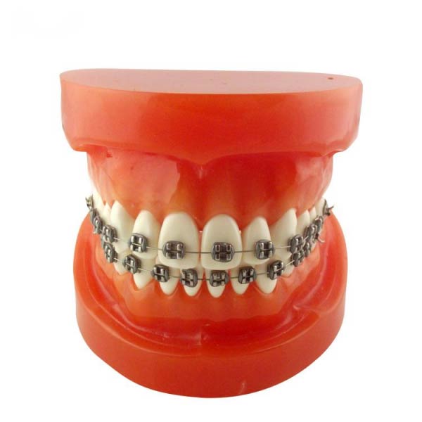 نموذج تقويم الأسنان (أقواس معدنية)