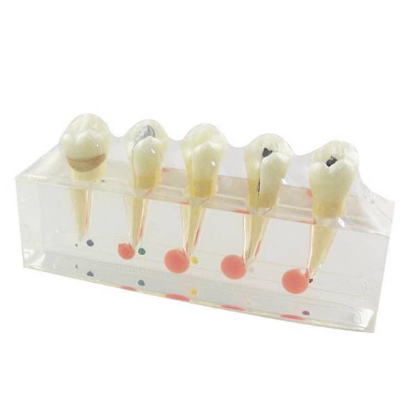 النموذج السريري لأمراض لب الأسنان والأسنان
