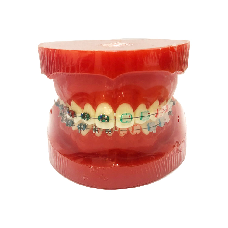 نموذج تقويم الأسنان (نصف معدن ونصف قوسين Ceremic)